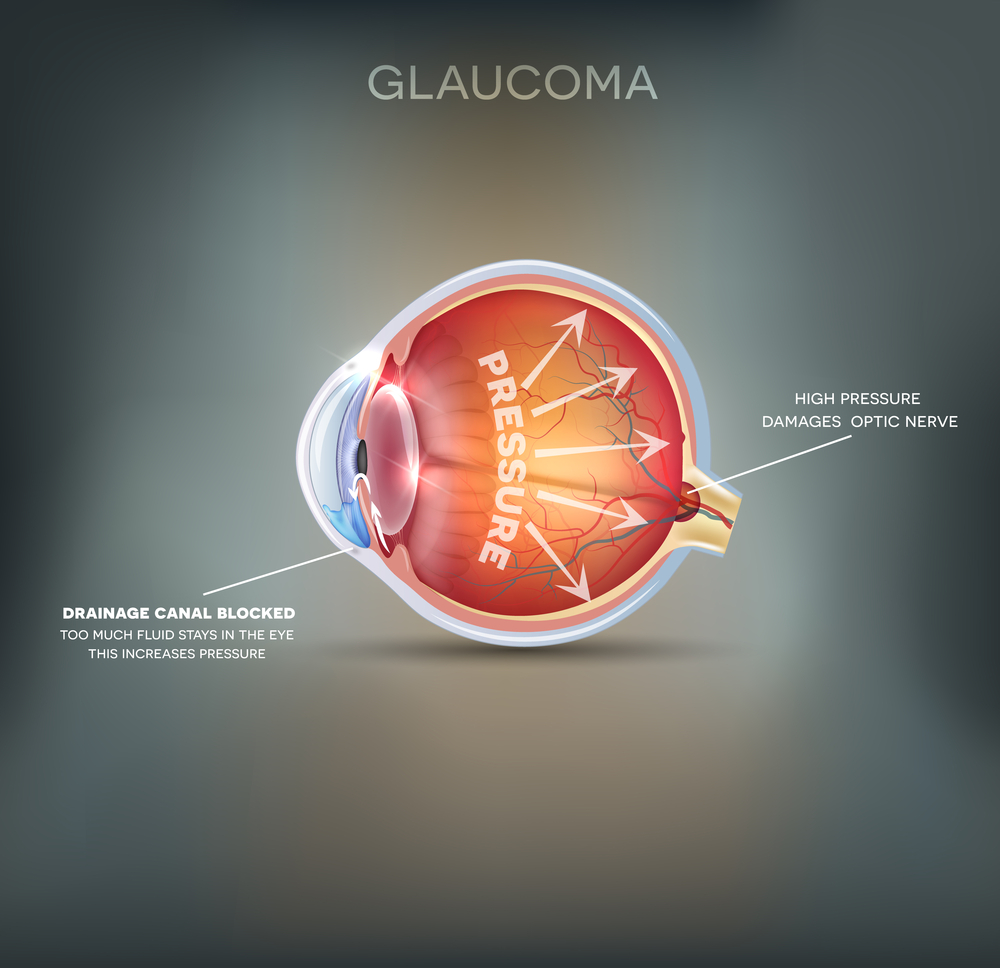 schedule yearly appointments with our ophthalmologists at Museum District Eye Center in Houston so that they can treat glaucoma right away should it arises. 